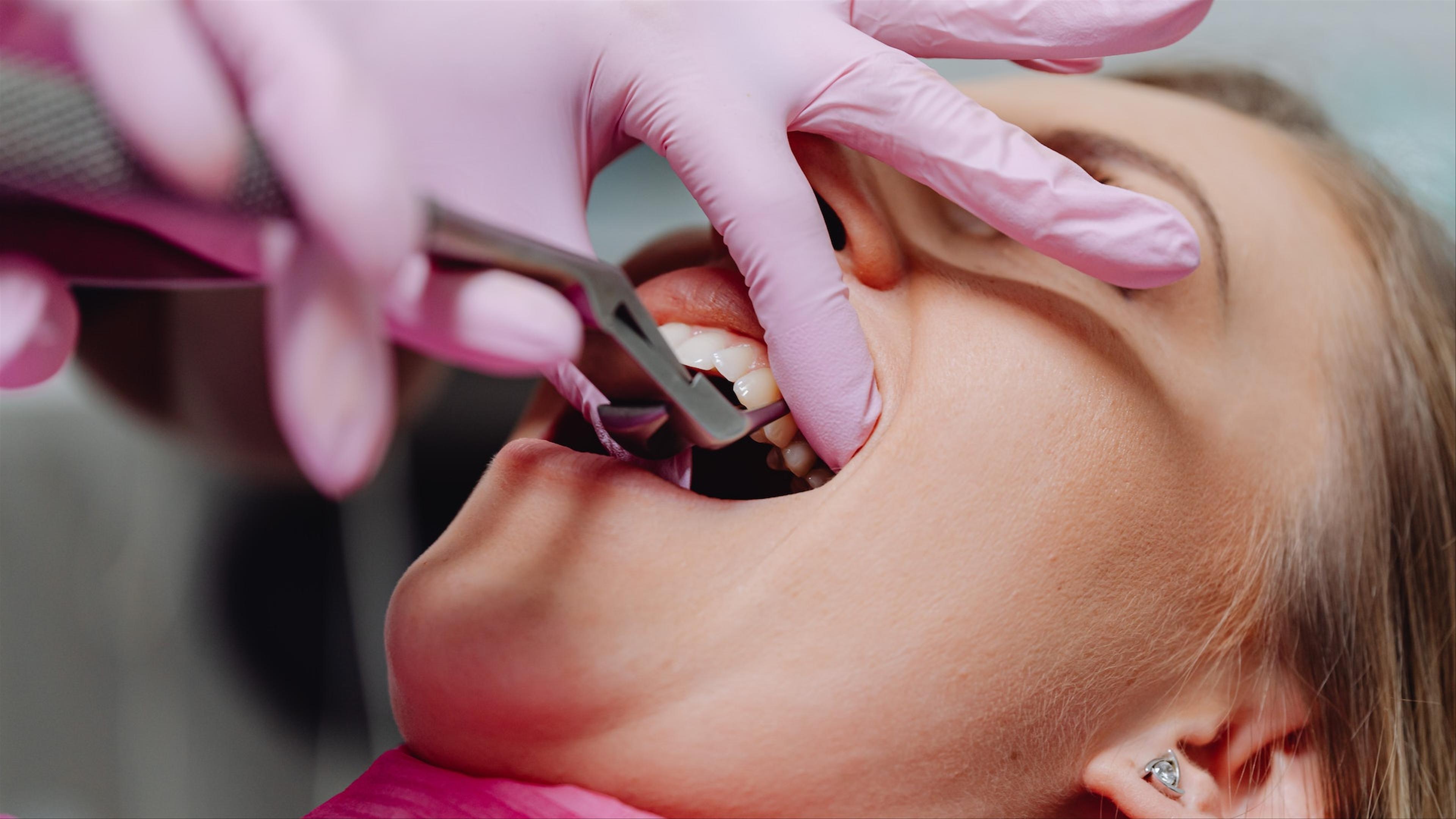 Dentist performing a tooth extraction procedure