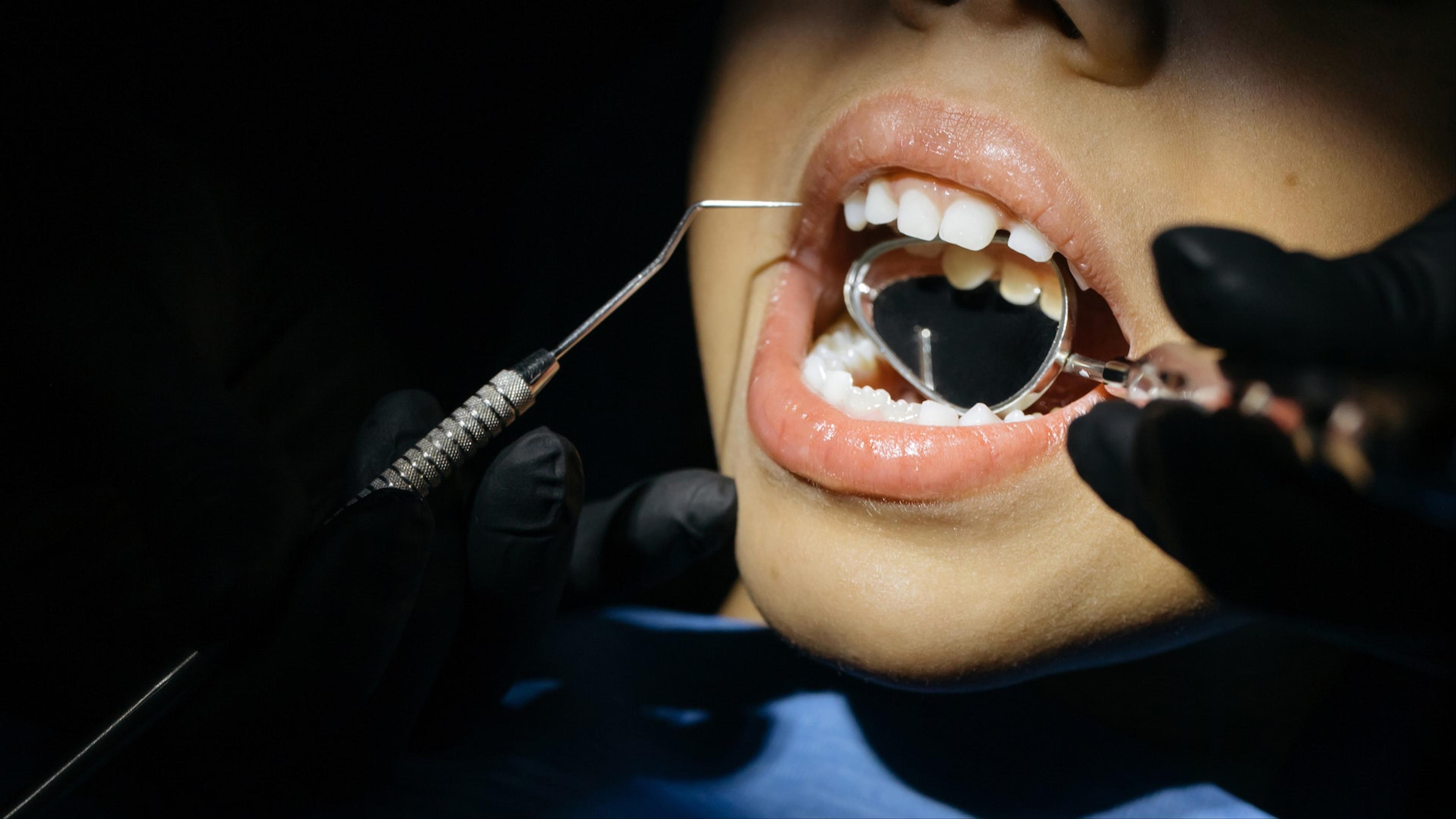 Patient with gapped teeth before treatment at Klinik Pergigian T3