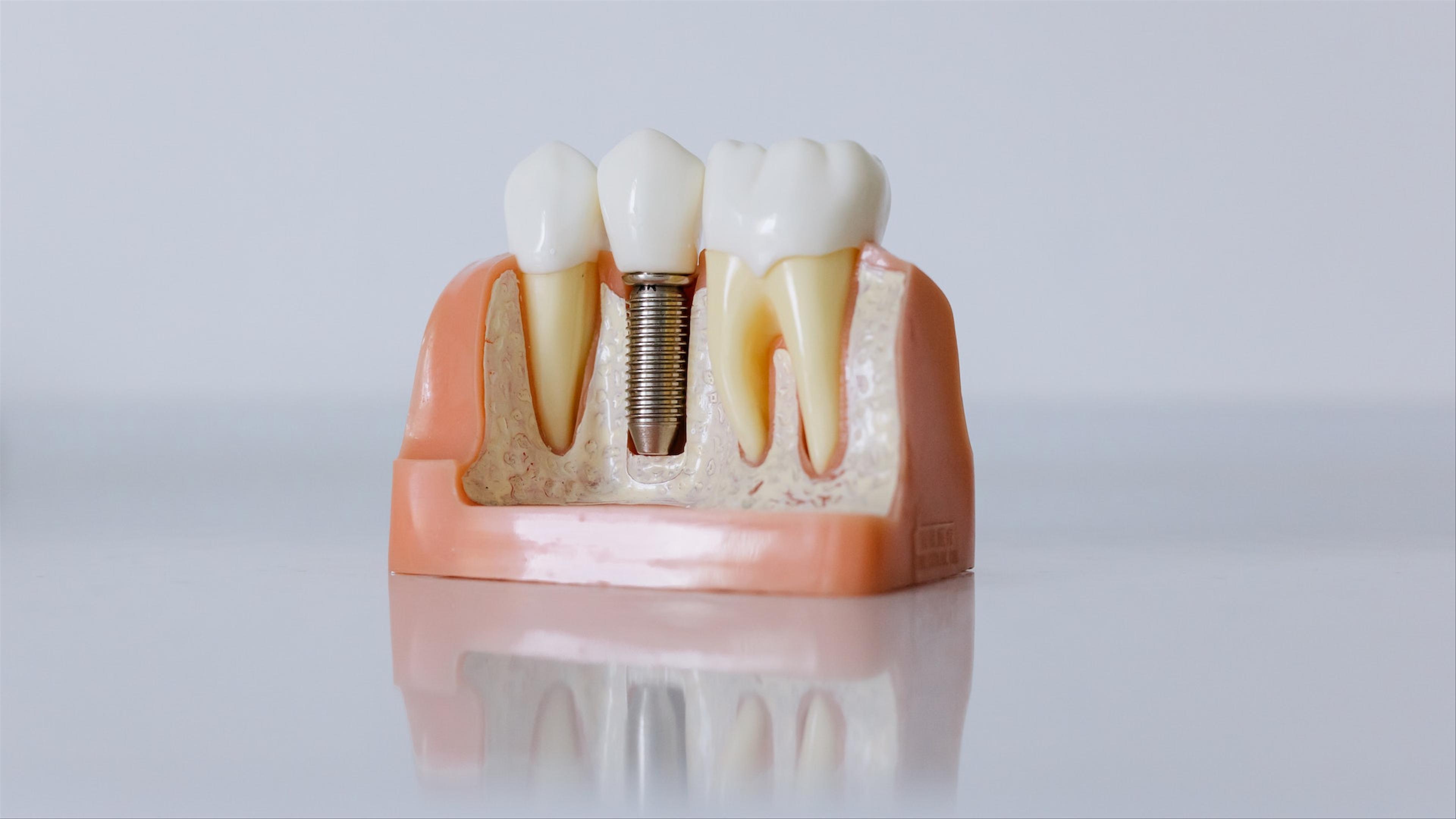 Dental implant model displayed at Klinik Pergigian T3